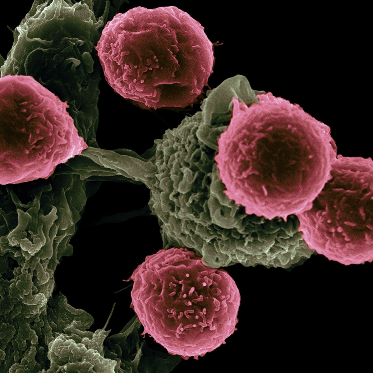 Cancer-Un-nouveau-traitement-efficace-contre-certains-cancers-en-phase-terminale