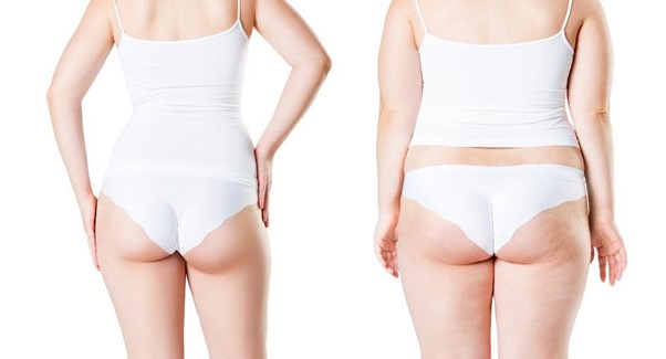 liposuccion femme
