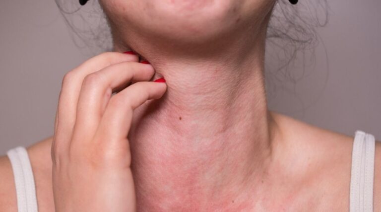 allergies