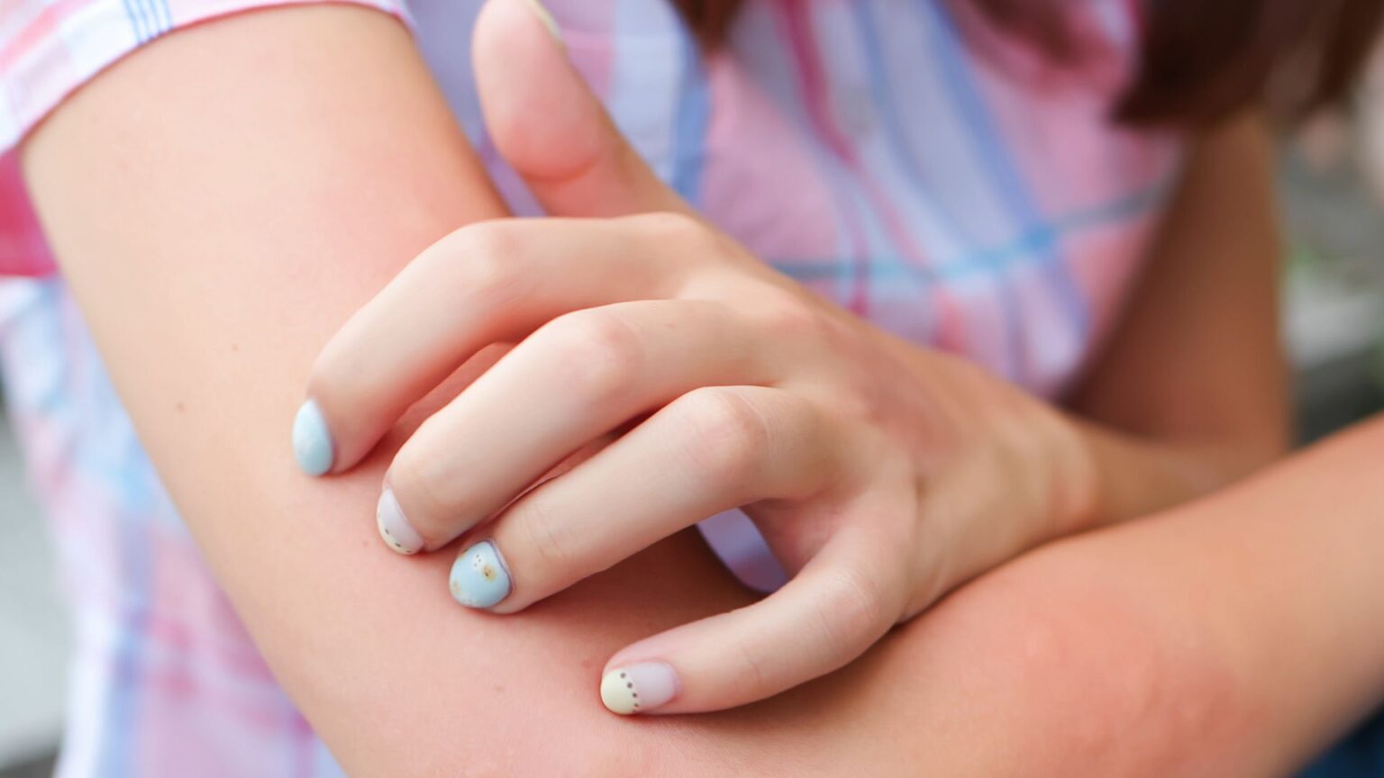 Piqûres de blattes : dites stop grâce à Eco Hygiène 3D, l’entreprise de désinsectisation en région PACA ! piqure