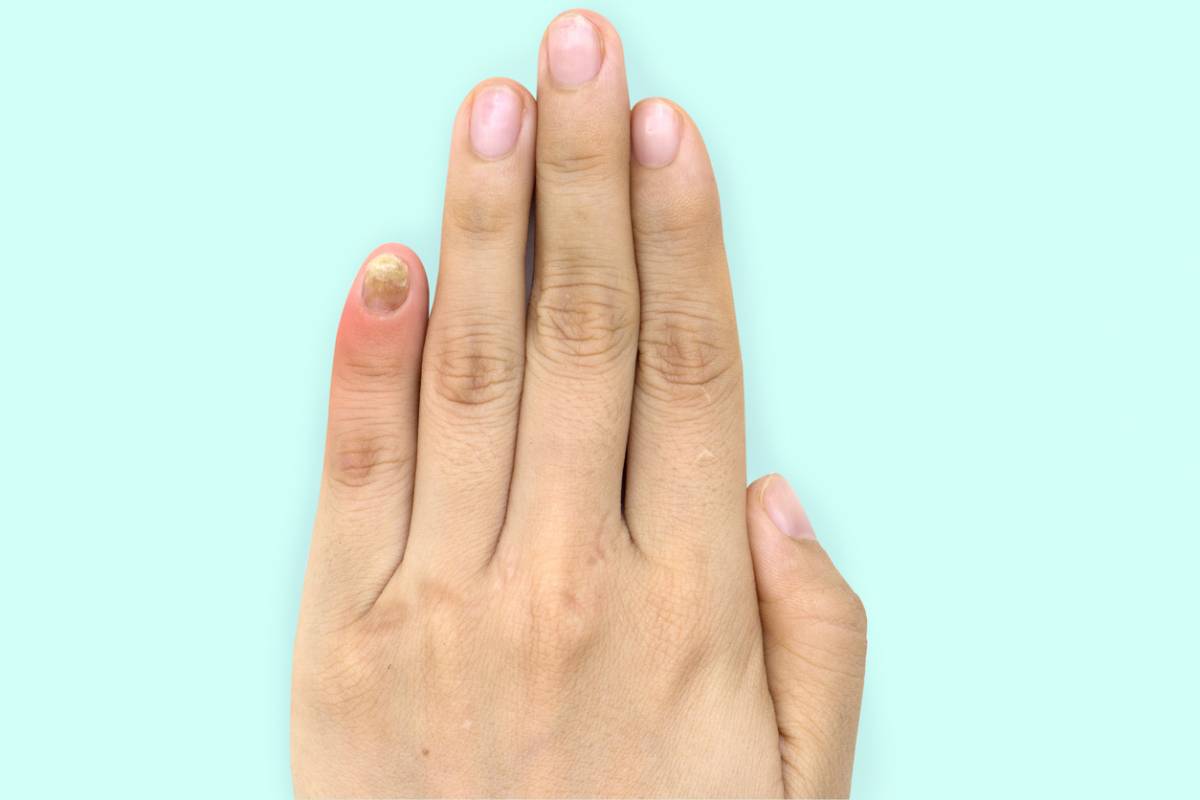 Comment traiter efficacement le psoriasis ongle Plare