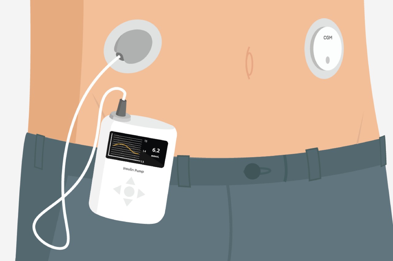 1714644694 394 Le concept de moniteur de glucose et de pompe a - plare.