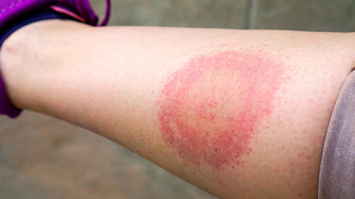 photo informativa enfermedad de Lyme