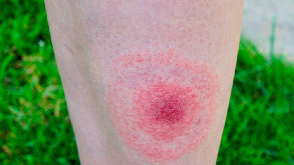 Justin Timberlake : son combat contre la maladie de Lyme et ses répercussions sur la sensibilisation sociale