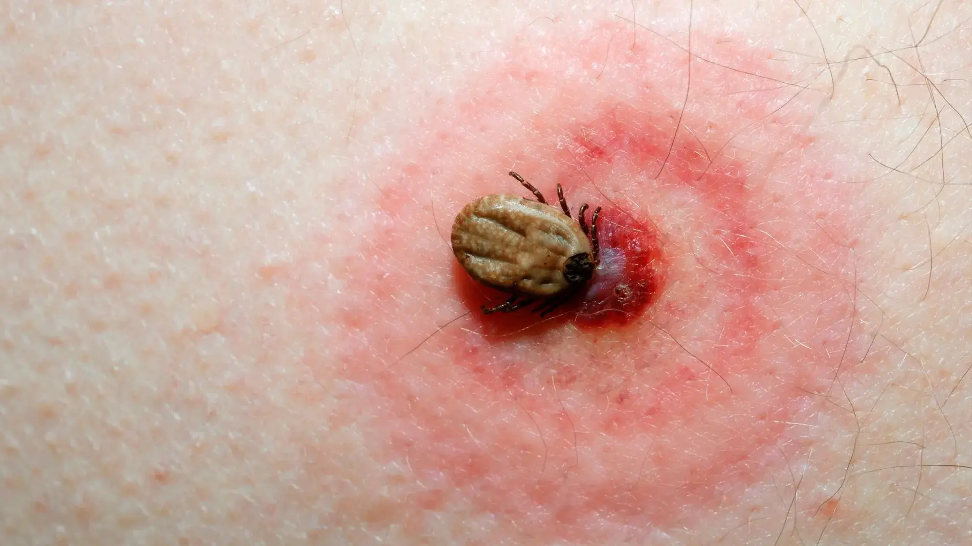 enfermedad de lyme síntomas y complicaciones