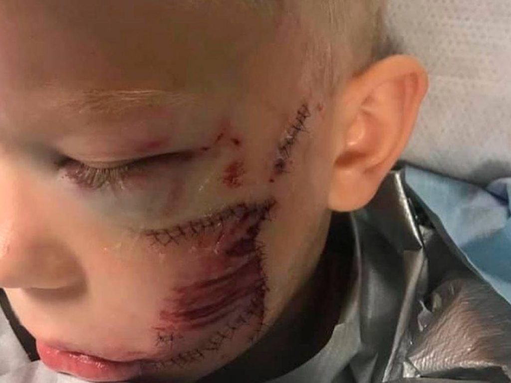 Enfant mordu au visage par un chien à Córdoba : intervention chirurgicale urgente en vue de son rétablissement