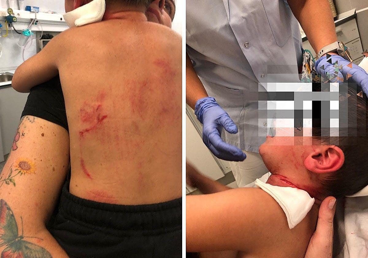 Niño herido por mordedura de perro en Alzira